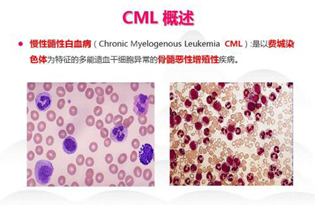 慢粒白血病用格列卫能治好吗