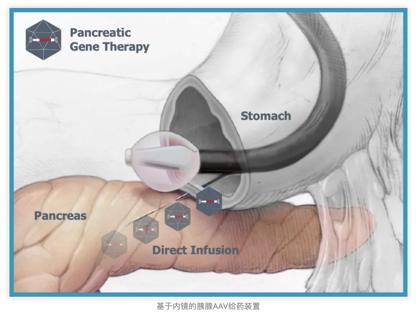 基于內(nèi)鏡的胰腺AAV給藥裝置