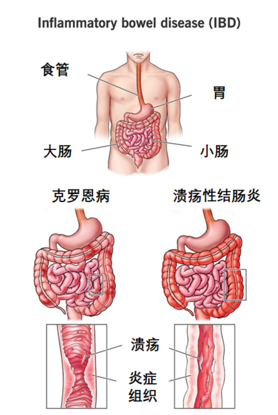 图1. 溃疡性结肠炎和克罗恩病发病部位及受损组织示意图。（图片来源：Cleveland Clinic）