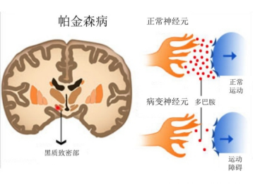 帕金森病發(fā)病機(jī)制