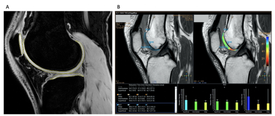 定量 MRI 分析