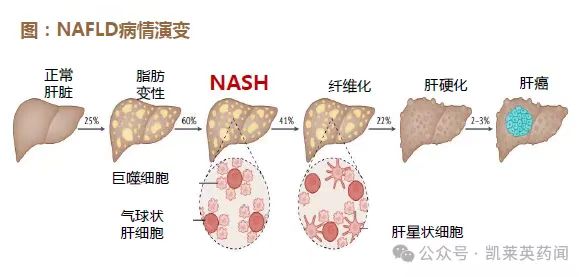 NAFLD病情演變