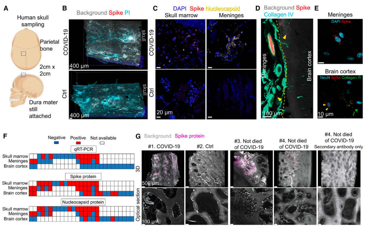 新冠患者的顱骨、腦膜和腦組織顯示刺突蛋白分布廣泛