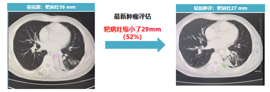 患者的靶病灶尺寸從 56mm 縮小至 27mm