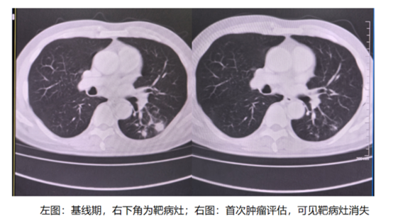 左圖：基線期，右下角為靶病灶；右圖：首次腫瘤評估，可見靶病灶消失