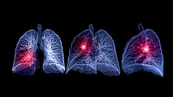 FDA特批！宗艾替尼挺进NSCLC一线，口服TKI正面奇袭ADC？