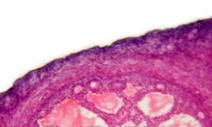 Evidence mounts linking aspirin to lower risk of ovarian cancer