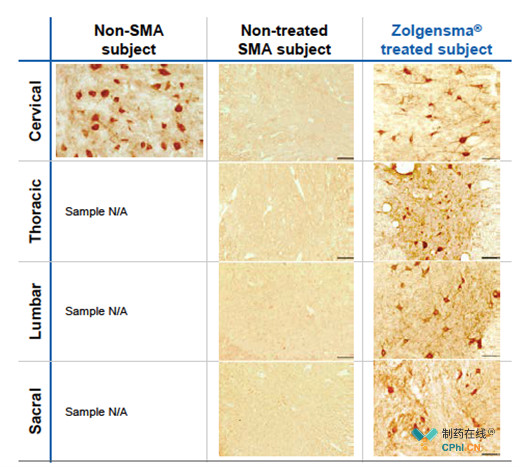 Zolgensma：一次性脊髓性肌萎缩基因疗法