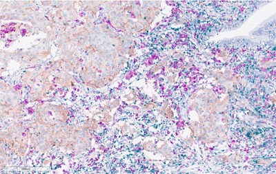 Multiplex stain for CD3 (green), PD-L1 (brown), CD68 (pink) on non-small cell lung carcinoma (NSCLC) patient sample