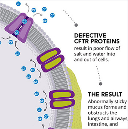 ▲CF由CFTR蛋白功能异常造成，影响细胞的水、氯离子平衡，最终导致肺部等多种器官功能障碍（图片来源：Vertex官网）