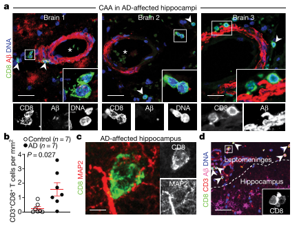  CD8+T细胞在AD患者脑内表达