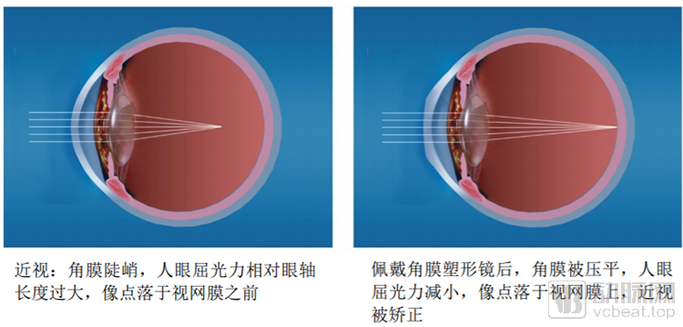 角膜塑形镜的作用原理