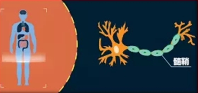 MS-中枢神经系统慢性炎性脱髓鞘性疾病