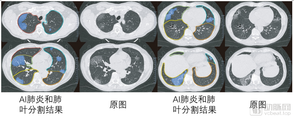 基于深度学习的肺炎分割和肺叶分割效果示意图