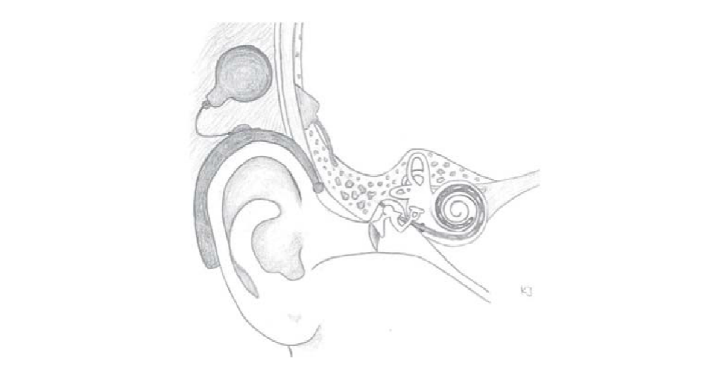 人工耳蜗原理示意图