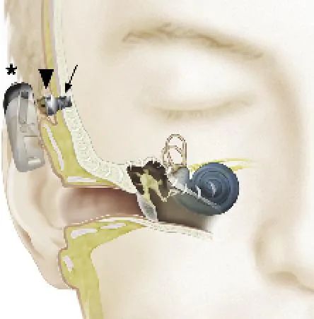 骨导助听装置的组成示意图