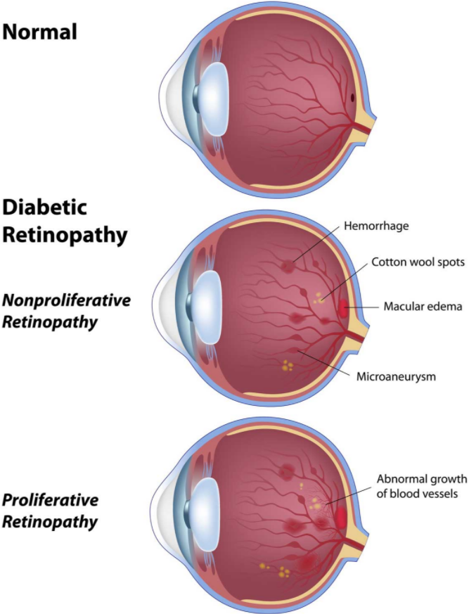 正常眼球和糖尿病视网膜病变（增殖性和非增殖性）