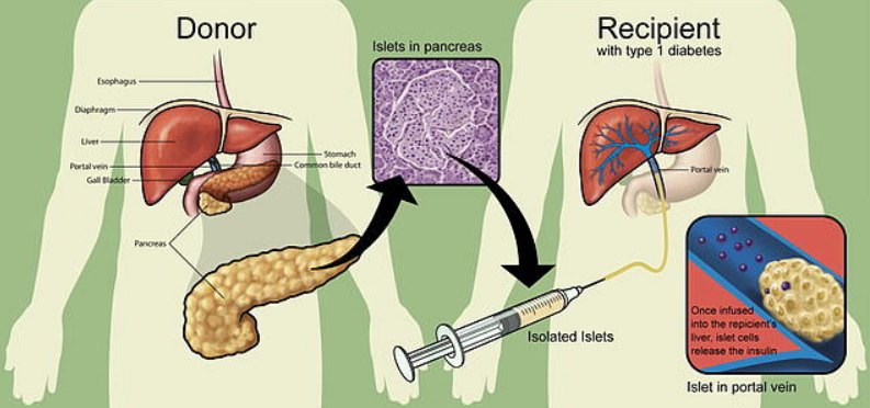 胰岛移植治疗糖尿病的临床过程