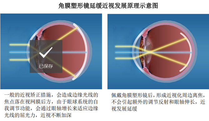 角膜塑形镜延缓近视发展原理