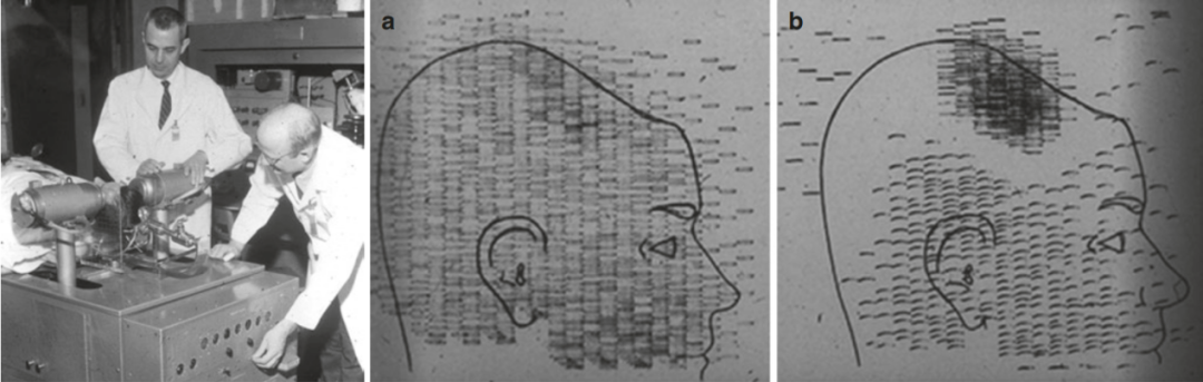 左：由Brownell和Sweet开发的用正电子发射的放 射性核素对脑瘤进行定位的多探头仪器。右：该扫描仪的图像显示了脑瘤的存在（图像b）