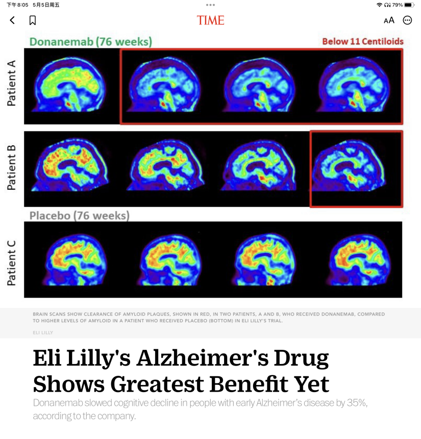 礼来阿尔兹海默症新药疗效最 佳，相关新闻登上了不少主流媒体