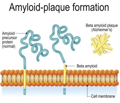 Amyloid-plaque formation