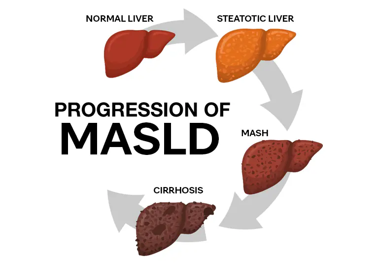 代谢相关脂肪性肝病MASLD的进展