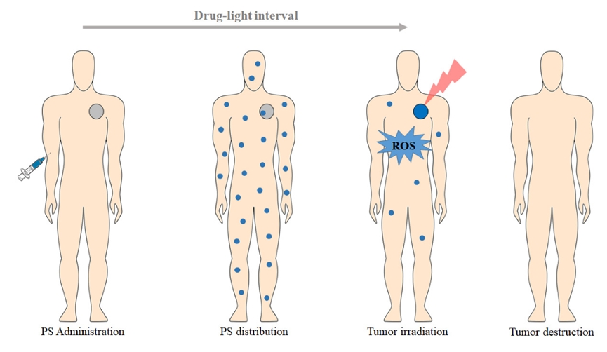 在实体肿瘤治疗中的PDT临床应用方案