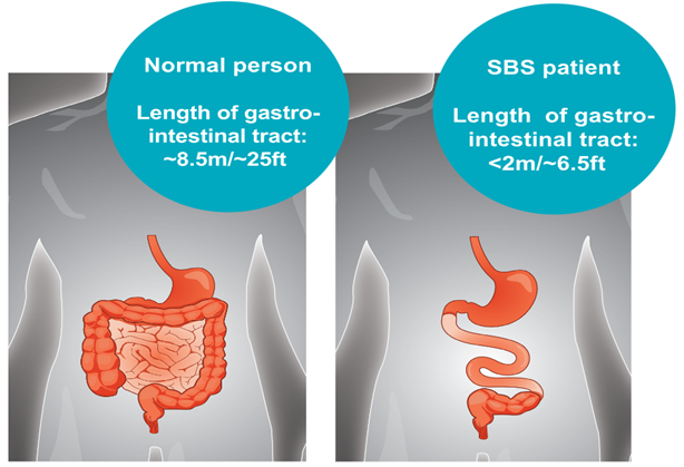 短肠综合征（简称SBS）是由于小肠较短，功能较弱所引起的吸收异常，主要症状是腹泻，其可导致脱水，营养不良和体重减轻。
