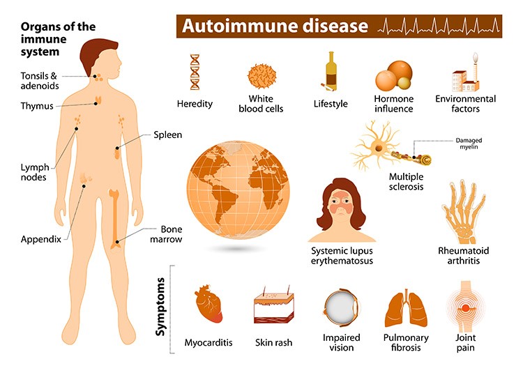 自免疫疾病影响的身体器官、症状和诱因。