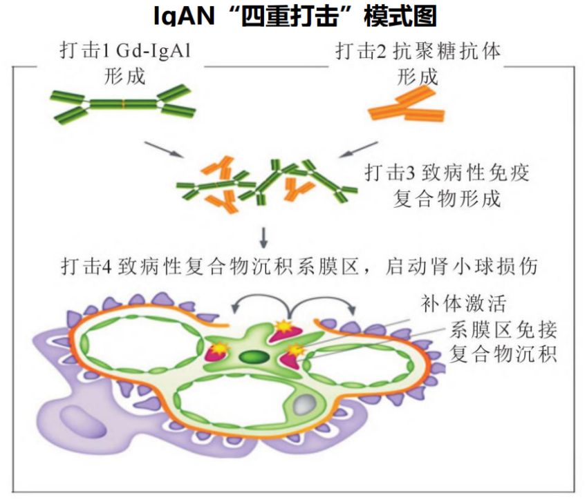 关于IgAN的发病机制，目前比较公认的是的“四重打击”学说