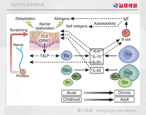特應(yīng)性皮炎的發(fā)病機(jī)制