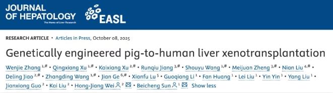 Genetically engineered pig-to-human liver xenotransplantation